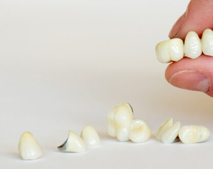 Bacteria Under a Dental Crown: Risks, Symptoms, and Solutions